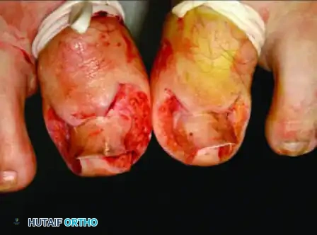 NAIL FOLD REMOVAL OR REDUCTION Surgical Diagram