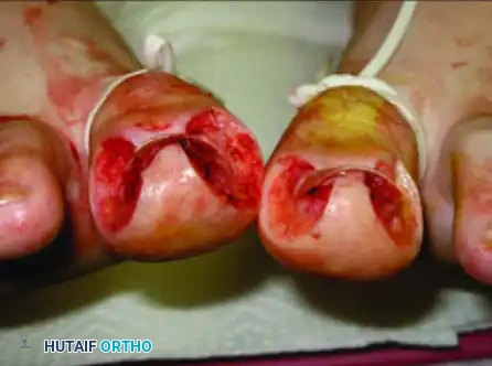 NAIL FOLD REMOVAL OR REDUCTION Surgical Diagram