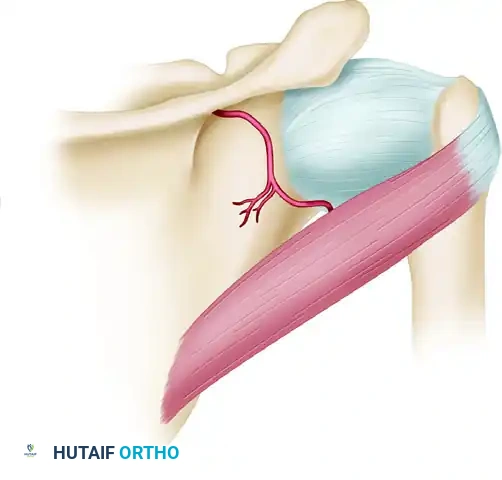 NEER INFERIOR CAPSULAR SHIFT PROCEDURE THROUGH A POSTERIOR APPROACH Surgical Diagram