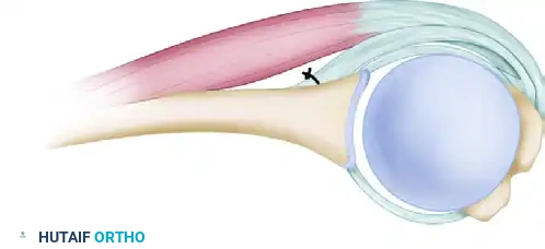 NEER INFERIOR CAPSULAR SHIFT PROCEDURE THROUGH A POSTERIOR APPROACH Surgical Diagram