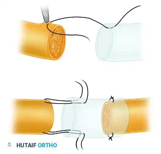 Peripheral Nerve Grafting: Principles, Donor Selection, and Microsurgical Techniques