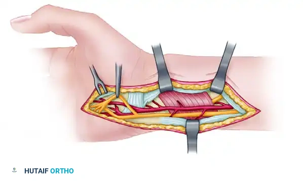 Nerve Transfer and Coaptation