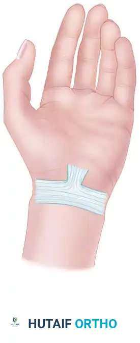 Ulnar Nerve Reconstruction and Cubital Tunnel Syndrome: Advanced Surgical Management