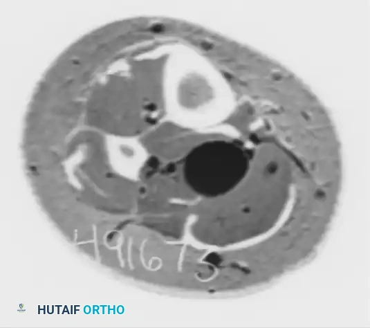 Axial CT Scan of Neurilemoma