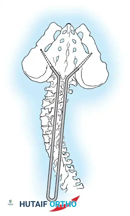 Neuromuscular Scoliosis: Comprehensive Surgical Management and Spinopelvic Fixation