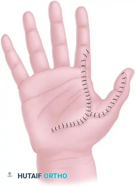 NEUROVASCULAR ISLAND GRAFT TRANSFER Surgical Diagram
