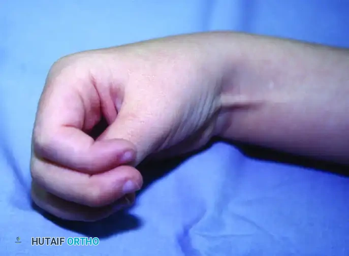 Management of the Spastic Upper Extremity: Nonoperative Strategies and Surgical Reconstruction