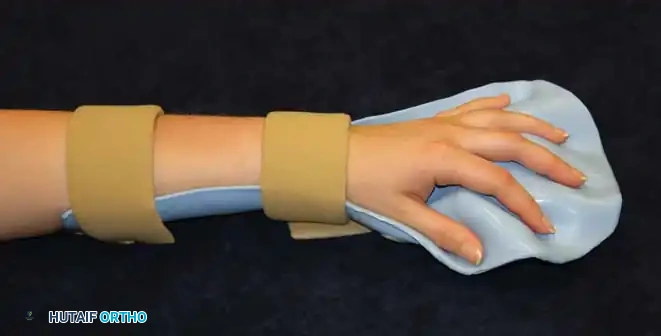 Fig. 69-2 Splint for spastic hand.