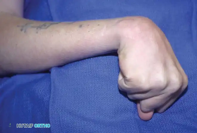 Fig. 69-1 Typical upper extremity deformities in cerebral palsy. Elbow fl exion, forearm pronation, and wrist and fi nger fl exion.