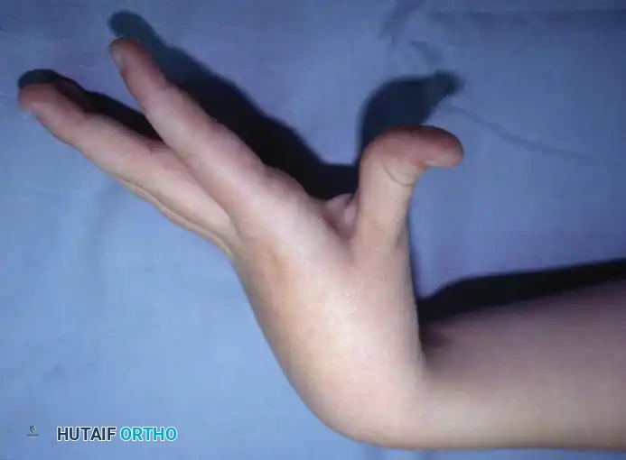 NONOPERATIVE MANAGEMENT Surgical Diagram