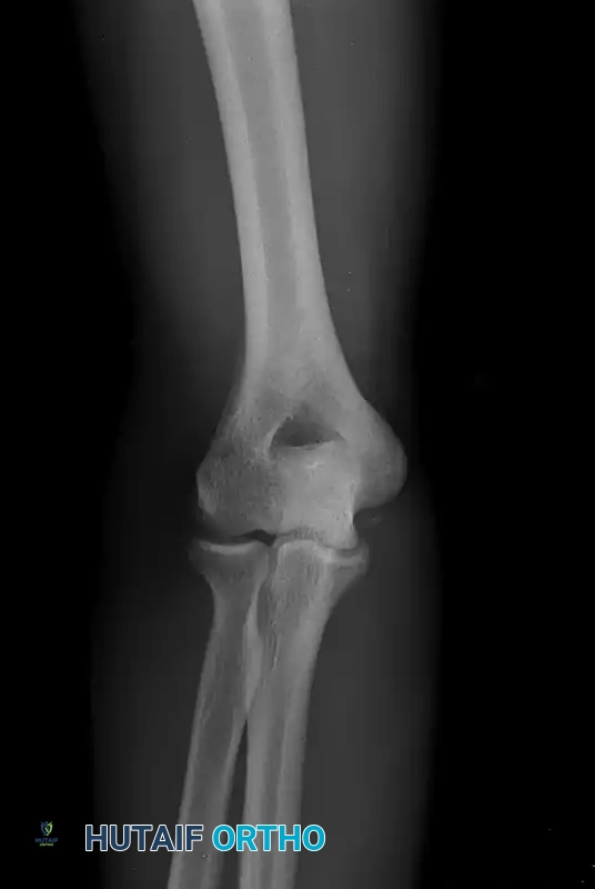 NONOPERATIVE TREATMENT Surgical Diagram