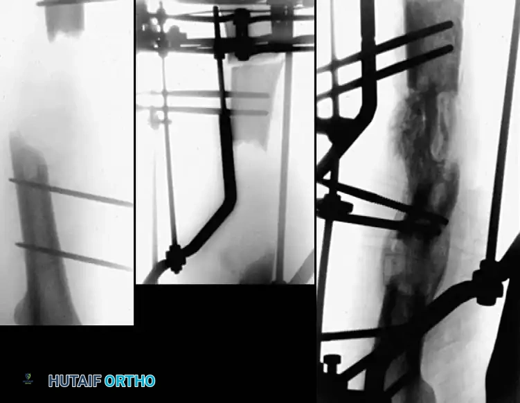 مخطط جراحي لتثبيت العظام