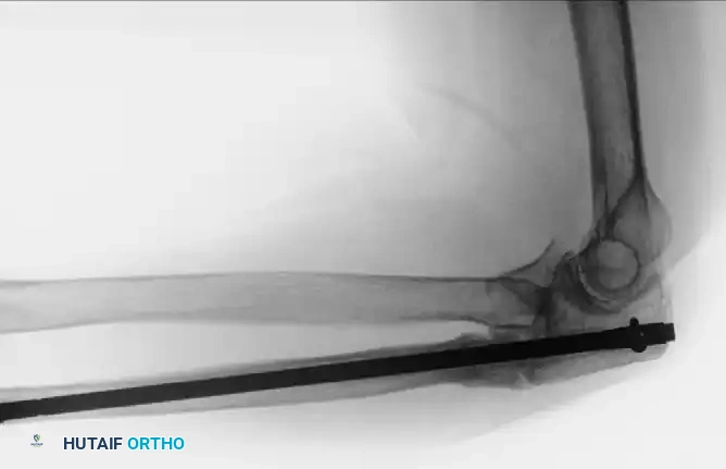 Operative Management of Monteggia and Distal Humerus Nonunions