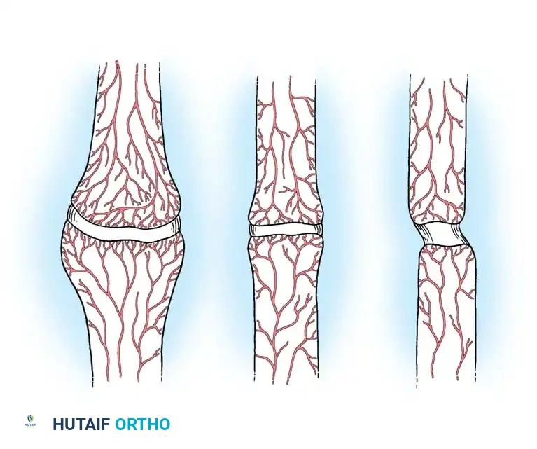 NONUNION Surgical Diagram