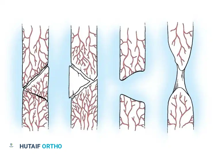 NONUNION Surgical Diagram