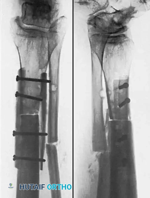 Operative Management of Fracture Nonunions: A Comprehensive Guide
