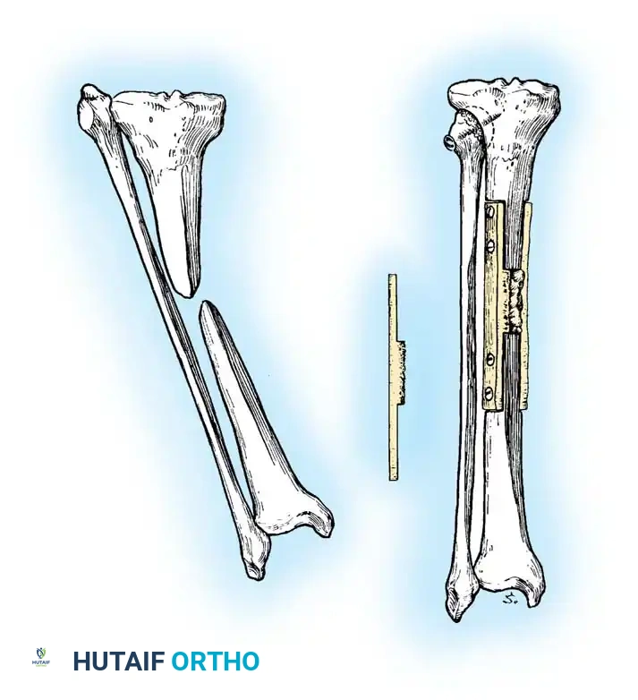 NONUNION Surgical Diagram