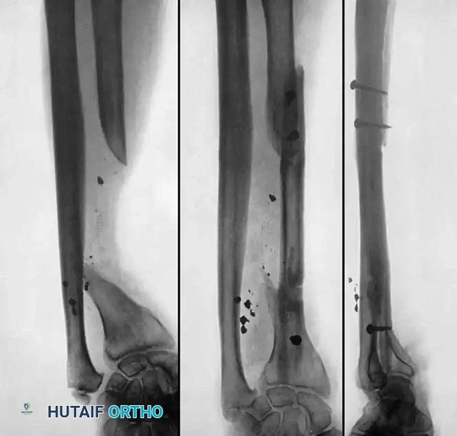 NONUNION Surgical Diagram