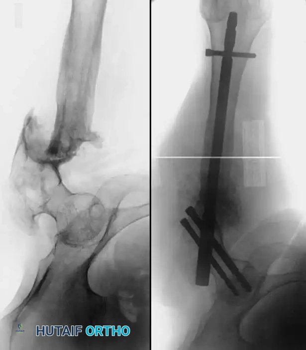 NONUNION Surgical Diagram