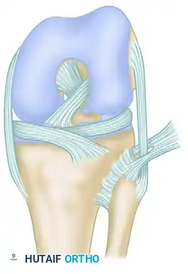 Chronic Unreduced Proximal Tibiofibular Joint Dislocations: Comprehensive Surgical Management