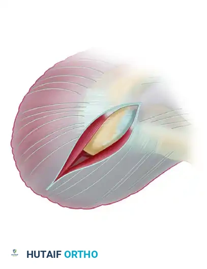 Deltoid origin elevated from the acromion