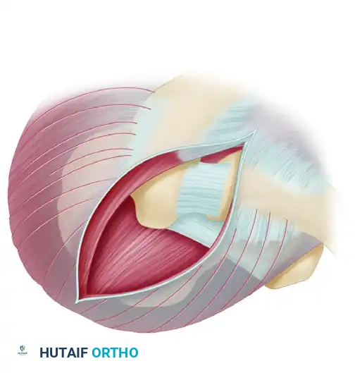 Anterior extent of the acromion to be resected