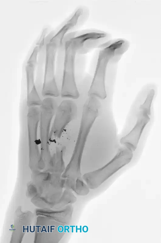 Management of Open Hand Fractures & Dislocations