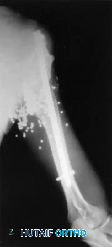 إصابات الطلق الناري منخفض السرعة وتأثيرها على العظام