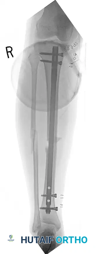 النتيجة النهائية لتثبيت الكسر المفتوح وإنقاذ الطرف