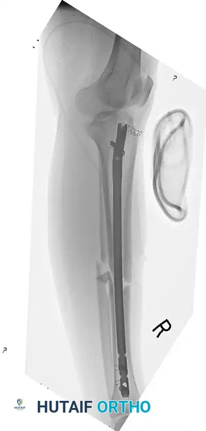 خطوات التثبيت الجراحي للكسور المفتوحة المعقدة