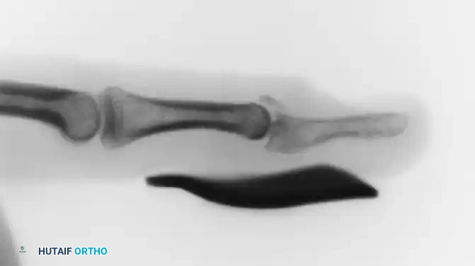 OPEN REDUCTION AND FIXATION WITH A KIRSCHNER WIRE Surgical Diagram