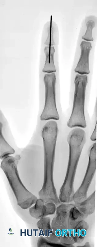 OPEN REDUCTION AND FIXATION WITH A KIRSCHNER WIRE Surgical Diagram