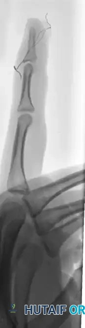 OPEN REDUCTION AND FIXATION WITH A KIRSCHNER WIRE Surgical Diagram