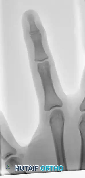 OPEN REDUCTION AND FIXATION WITH A KIRSCHNER WIRE Surgical Diagram
