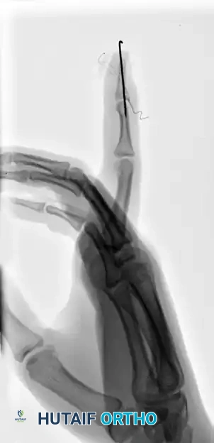 OPEN REDUCTION AND FIXATION WITH A KIRSCHNER WIRE Surgical Diagram