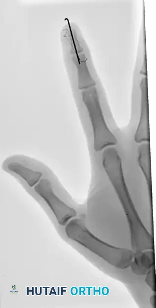 OPEN REDUCTION AND FIXATION WITH A KIRSCHNER WIRE Surgical Diagram