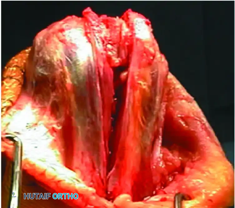 Supracondylar fracture intraarticular
