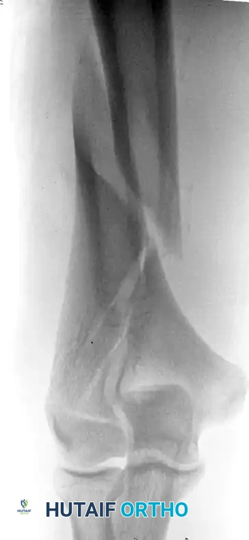 Distal intercondylar fracture fixed