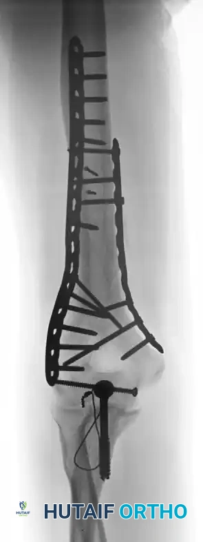 Small osteochondral fragment fixation