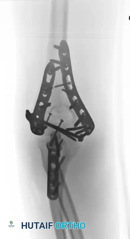Distal humeral fracture