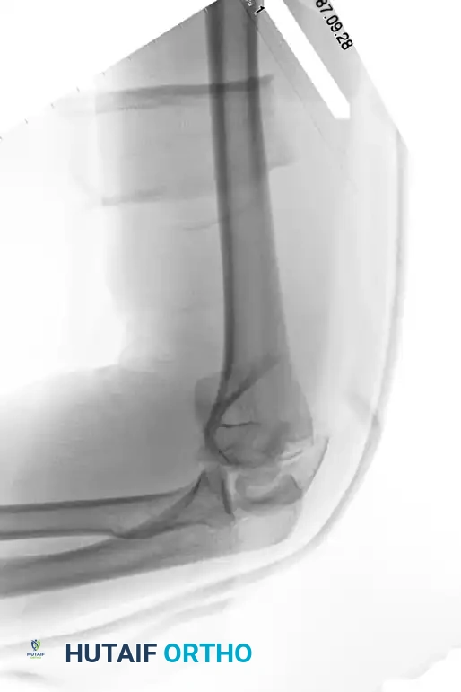 Direct medial lateral plate