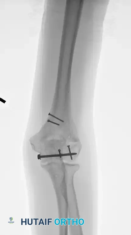 After hardware removal