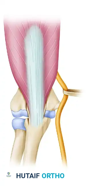 Osteotomized proximal olecranon elevated