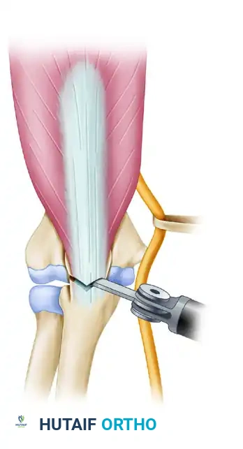 Provisional fixation
