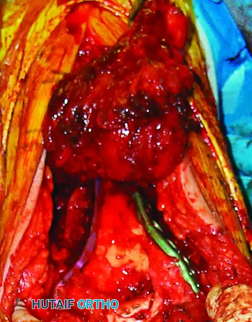 Repair olecranon osteotomy