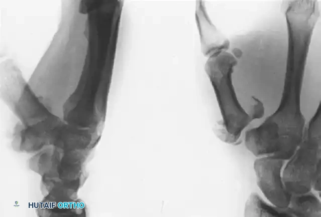 OPEN REDUCTION AND INTERNAL FIXATION Surgical Diagram