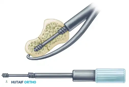 Long drill inserted to maximal depth