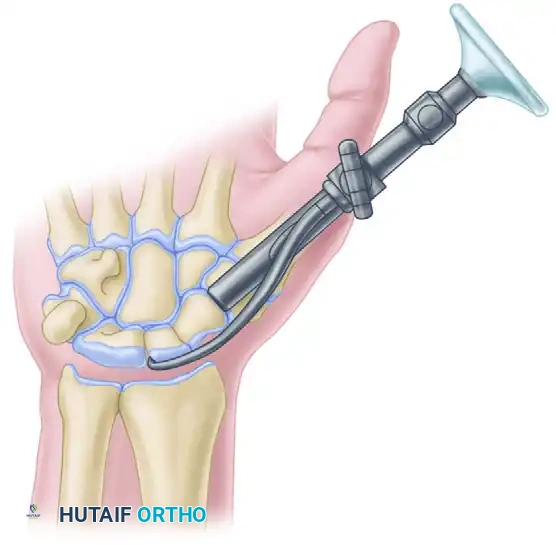 Herbert screw inserted