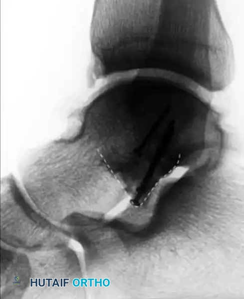 OPEN REDUCTION AND INTERNAL FIXATION OF FRACTURES OF THE LATERAL PROCESS OF THE TALUS Surgical Diagram