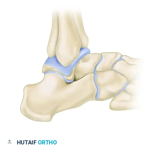 OPEN REDUCTION AND INTERNAL FIXATION OF FRACTURES OF THE LATERAL PROCESS OF THE TALUS Surgical Diagram